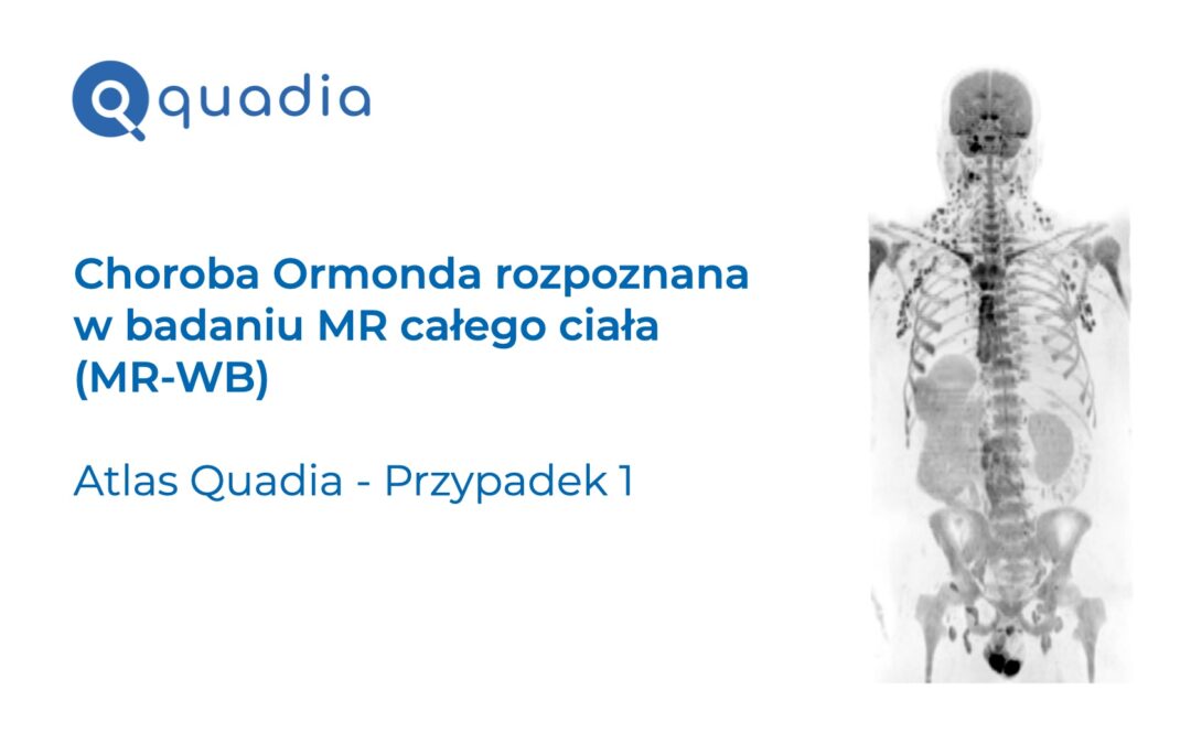 Przypadek 1 – Choroba Ormonda rozpoznana w badaniu MR całego ciała (WB-MR)