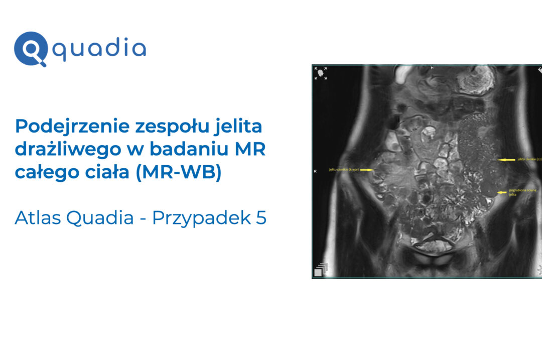Przypadek 5 – Podejrzenie zespołu jelita drażliwego (IBS) w badaniu MR całego ciała (MR-WB).