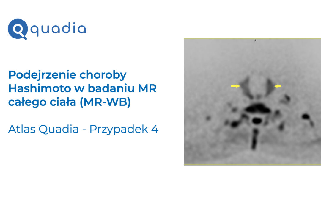 Przypadek 4 – Podejrzenie choroby Hashimoto w badaniu MR całego ciała (MR-WB).