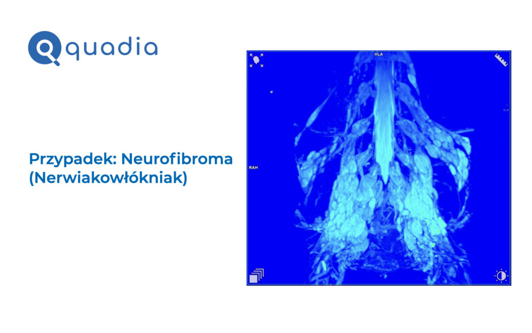 Neurofibroma (nerwiakowłókniak)