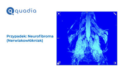 Neurofibroma (nerwiakowłókniak)
