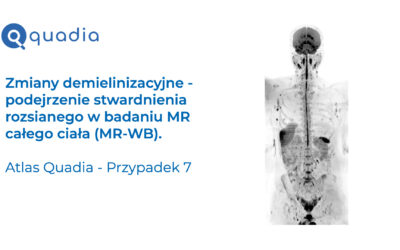 Przypadek 7 – Zmiany demielinizacyjne – podejrzenie stwardnienia rozsianego w badaniu MR całego ciała (MR-WB)
