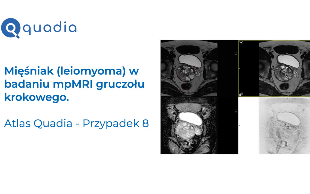 Przypadek 8 – Mięśniak (leiomyoma) w badaniu mpMRI gruczołu krokowego.