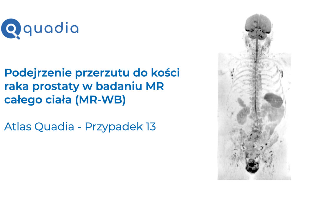 Przypadek 13 – Podejrzenie przerzutu do kości raka prostaty w badaniu MR całego ciała (MR-WB)